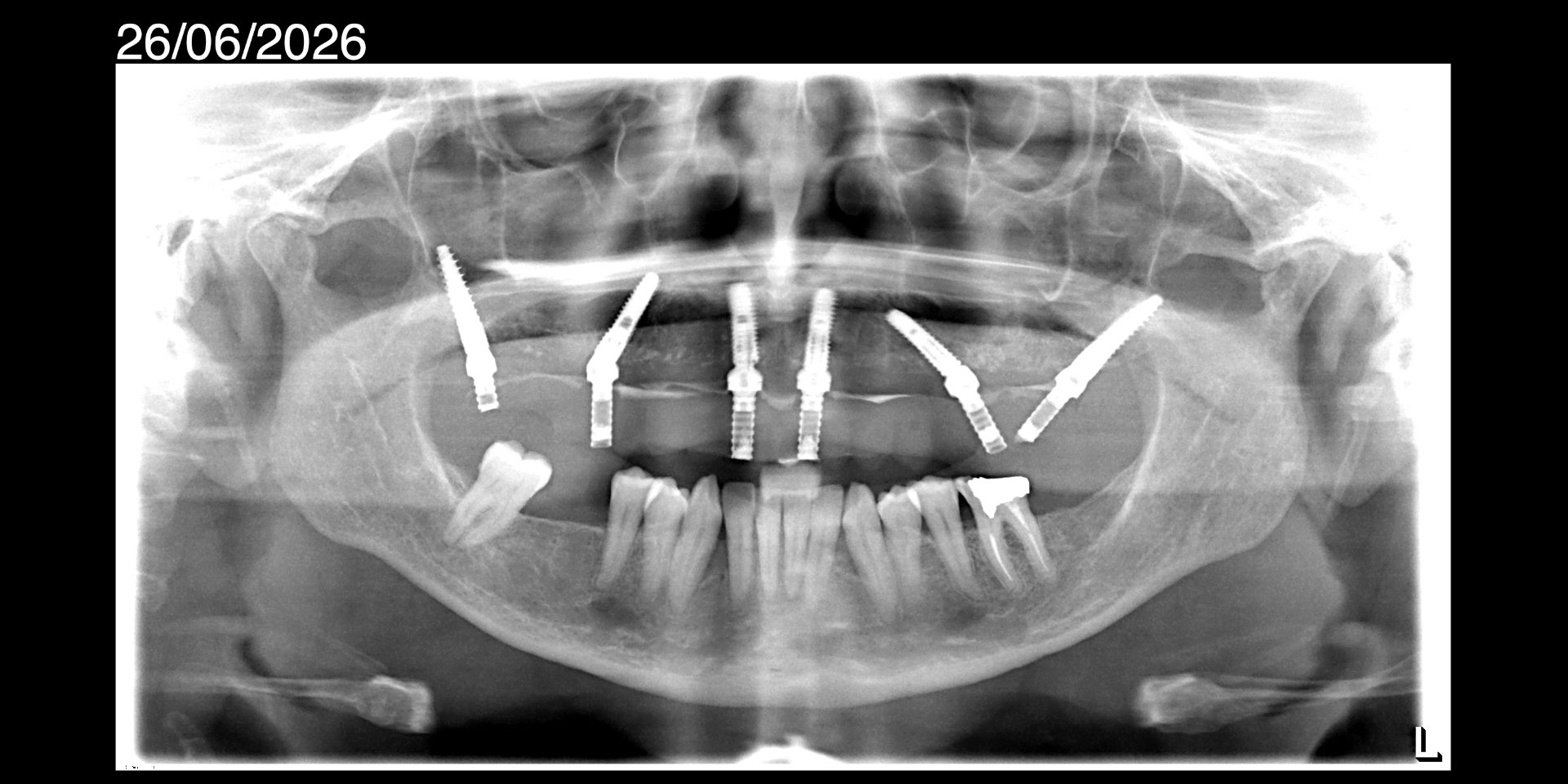 3-months-implant-placement
